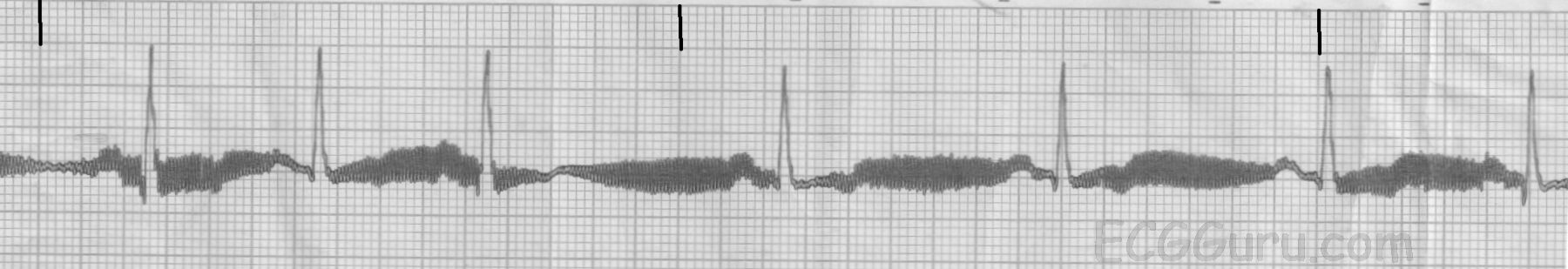 ecg-basics-60-cycle-artifact-ecg-guru-instructor-resources